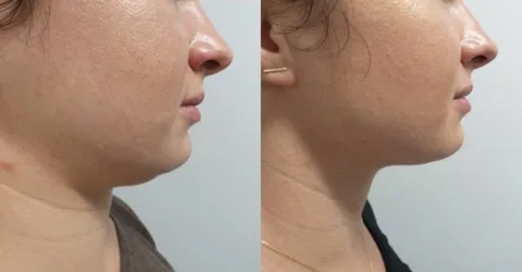 Antes e Depois