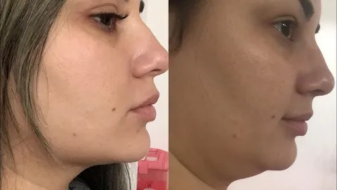 Antes e Depois