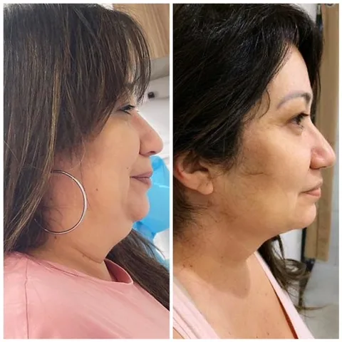 Antes e Depois