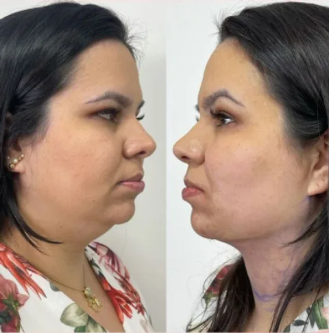 Antes e Depois